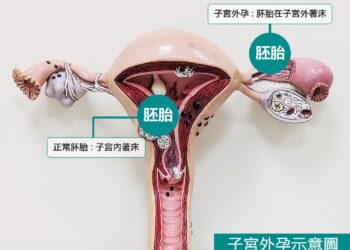▲「異位妊娠」（俗稱子宮外孕）是胚胎著床於子宮腔外的位置，其中超過九成五發生於輸卵管。（圖／東港安泰醫院提供）