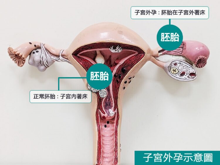 ▲「異位妊娠」(俗稱子宮外孕)是胚胎著床於子宮腔外的位置,其中超過九成五發生於輸卵管。(圖/東港安泰醫院提供)