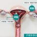 ▲「異位妊娠」（俗稱子宮外孕）是胚胎著床於子宮腔外的位置，其中超過九成五發生於輸卵管。（圖／東港安泰醫院提供）