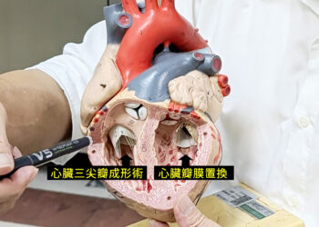 ▲86歲阿嬤心臟的二尖瓣瓣膜及三尖瓣瓣膜都嚴重的閉鎖不全。（圖／東港安泰醫院提供）